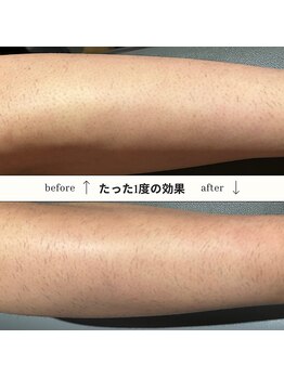 ドゥメール(DEMAILE)/都度払い 全身脱毛 効果絶大!