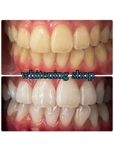 ホワイトニングショップ 大阪玉造店/Before&After美白ホワイトニング