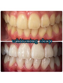 ホワイトニングショップ 大阪玉造店/Before&After美白ホワイトニング