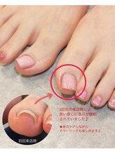 ケアプラス(care plus)/巻爪ケアジェル+シェラック