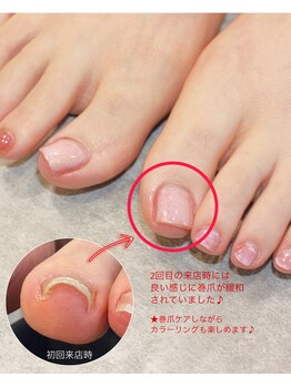 ケアプラス(care plus)/巻爪ケアジェル+シェラック