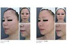 マシンケアは顔印象まで変化が見える最強です◎年齢は関係ない！