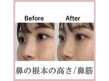 ラプリシュシュ 岡山店(Raplit)/ 隆鼻＋輪郭矯正40分10回