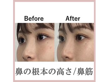 ラプリシュシュ 岡山店(Raplit)/ 隆鼻+輪郭矯正40分10回