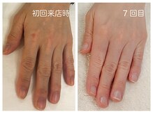 キレイテ 福岡天神店/50代/7回目【福岡ハンドケア】