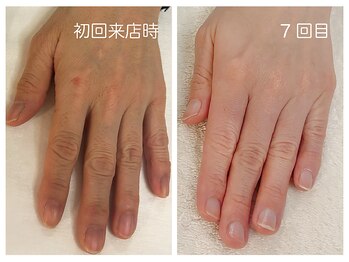 キレイテ 福岡天神店/50代/7回目【福岡ハンドケア】