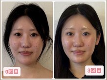 キプラ 福津店(KIPURA)の雰囲気（小顔矯正/毛穴/福津小顔/よもぎ蒸し福津/歪み/ほうれい線/左右差）