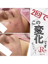 サロン ド レイ(Salon de Rei)/陶肌REVIハーブピーリング