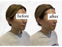 ビーアイリー(Be irie)/フェイシャルエステ直後の変化