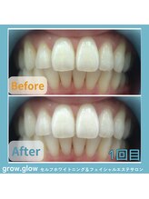 グロウ グロウ(grow.glow)/医療提携ホワイトニング