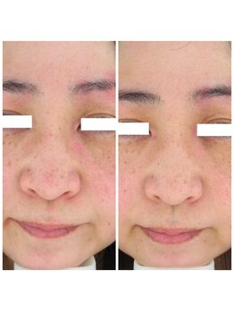 モモン シャルール/ヒト幹細胞で赤味肌のお悩み改善