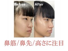 ラプリ 銀座店(Raplit)の雰囲気（顔と鼻を同時に整えます！他の症例もフォトギャラリーに多数あり）