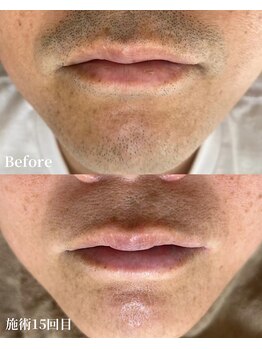 エース(ACE.)/ヒゲ脱毛☆清潔感アップ!