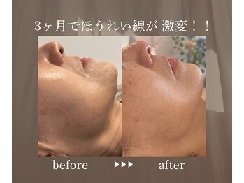 エメ(eme)/ほうれい線にお悩みの方