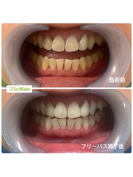ルブラン 奈良店(Le Blanc)/3週間で確実に白く!