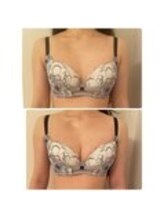 美人バスト 表参道店/体験◆初回バストアップ症例