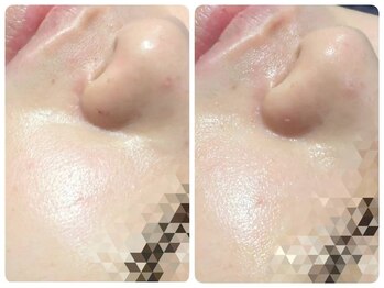 トータルビューティ ノイド(Noid)/毛穴洗浄　お試し全顔