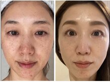 トータルエステティック ジョワイユ(JOYEUX)/美容○○に頼らなくてもこの結果