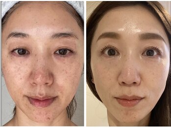 トータルエステティック ジョワイユ(JOYEUX)/美容○○に頼らなくてもこの結果