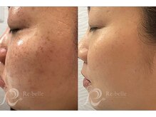 エルビービュティーサロン(LB BEAUTY SALON)/【ニキビ改善】ハーブピーリング