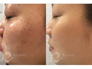 エルビービュティーサロン(LB BEAUTY SALON)/【ニキビ改善】ハーブピーリング