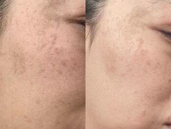 ラ ピュア ビン(LA PURE BIN)/ダイヤモンドピールの効果写真