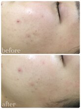 メイユール(MEILLEUR)/光フェイシャル1回