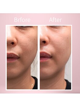 クラリ 栄院(CLARI)の写真/【毛穴汚れ/黒ずみ徹底ケア】自分では難しい毛穴ケアには水光ピールが◎つるんとした憧れのたまご肌に…♪