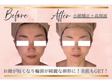 リーズリアン(Rises Lien)/【BeforeAfter】30代 リフトUP!