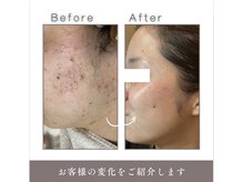 リノリー(rinory)の雰囲気（ワンクール6回の肌育成は根本からアプローチで土台を整えます◎）