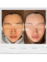 ライフ美容整体院 恵比寿(Life美容整体院)/ニキビ・毛穴ケア