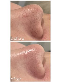 ネオファースト 大阪福島店(NeoFirst)の写真/目指せ毛穴レス！《ハイドラ毛穴洗浄×超音波毛穴洗浄×エレクトロポレーション》[ヒト臍帯血幹細胞]配合！