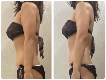 ソルニス(Solnis.)/痩身☆脂肪分解/ハイパーナイフ