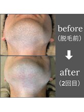 ブルーグロウ(Blue Glow)/ヒゲ脱毛ビフォーアフター
