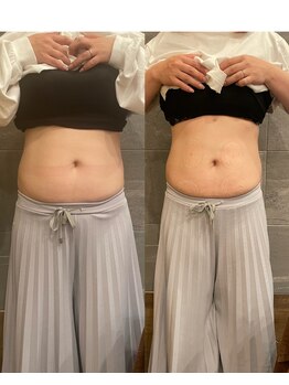 長寿鍼灸院 長寿整骨院/EMS<お腹集中コース>