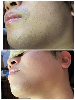 リンカ(Rinca)/髭脱毛4回目でこの変化!