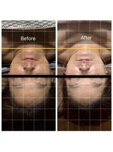 レグラージュ(Reglage)/艶肌＆小顔　Before＆After