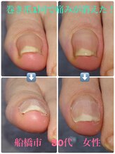 巻き爪じゅん 船橋店/巻き爪1回で楽になった！