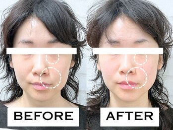 ビハリスト 麻布十番/目のクマとほうれい線が改善!