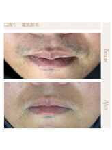 エスト(Est_.)/美容電気脱毛【鼻下】