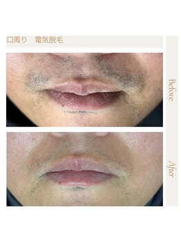 エスト(Est_.)/美容電気脱毛【鼻下】