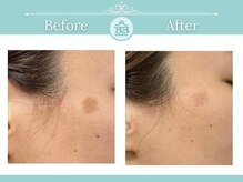 ゼロ美人 那覇店(ZERO美人)/【シミケア★シミケアZERO美人】