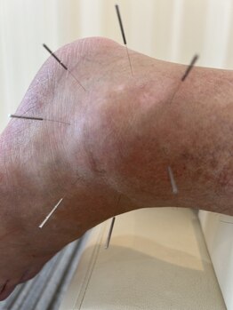 イワモト 水戸院(IWAMOTO)/外踝の浮腫