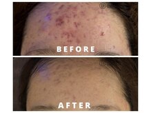 ビューティーワン(Beautyone)/LDM水玉リフティング/ニキビケア