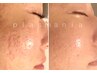 【プラズマニキビケア】肌トラブル改善・肌荒れ跡ケア　￥16,800→11,800