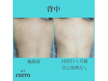 アクト クロ(ACT curro)/【背中上】脱毛施術例
