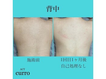 アクト クロ(ACT curro)/【背中上】脱毛施術例