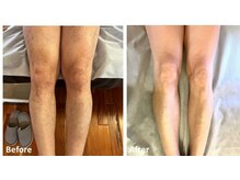 シェアキ(Chez Aki)/メンズ全身脱毛