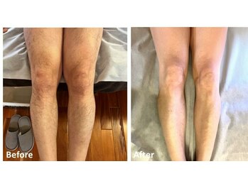 シェアキ(Chez Aki)/メンズ全身脱毛