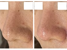 エス(es)/ハイドロピーリング